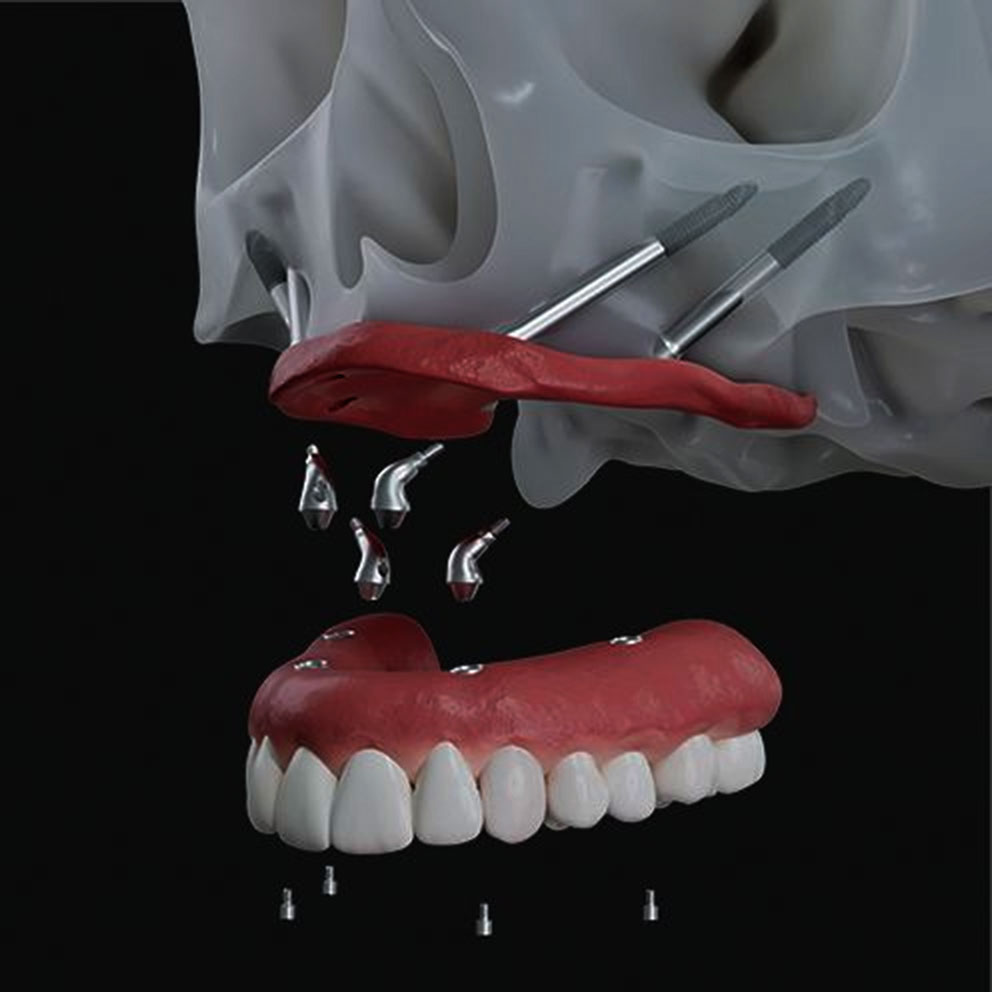 Implant Planning: The Foundation of Long-Term Success