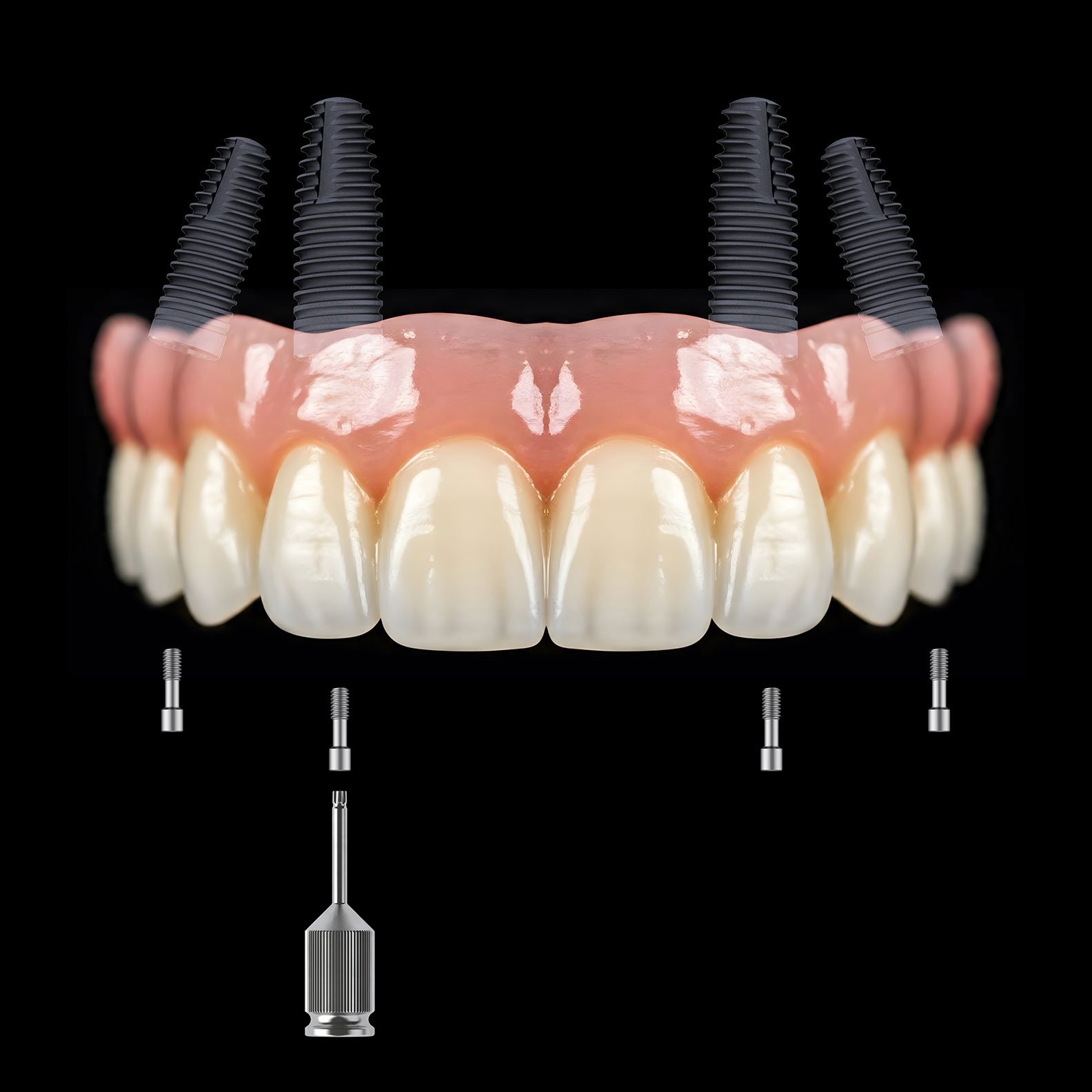 Immediate Implant Placement