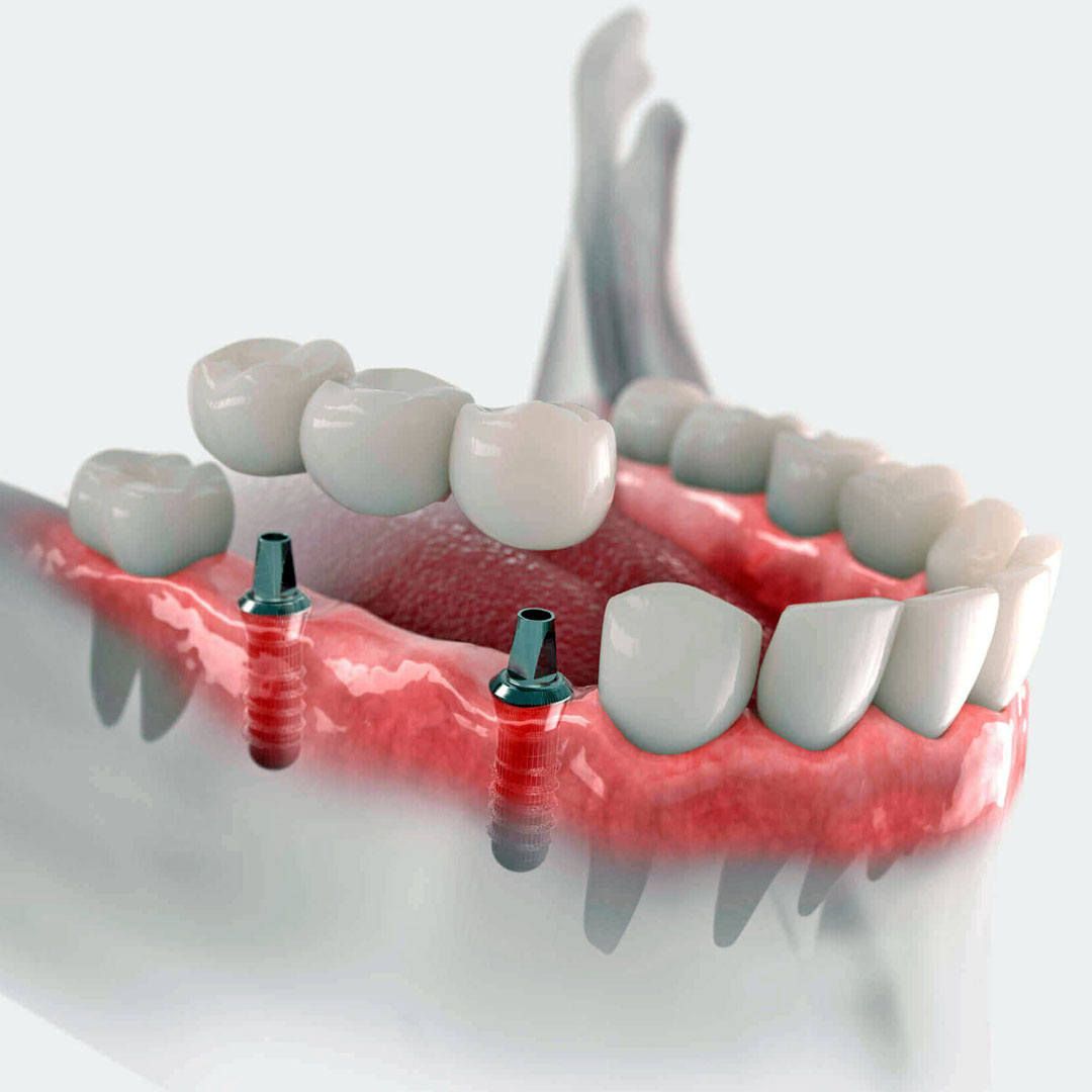 Timing of Dental Implant Placement After Tooth Extraction