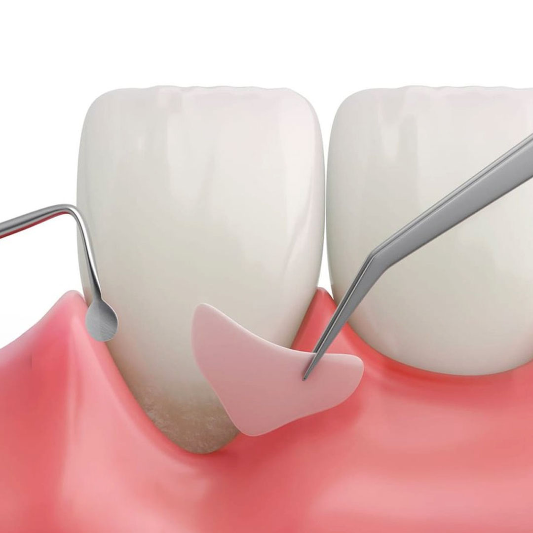 How Are Gum Grafts Performed?