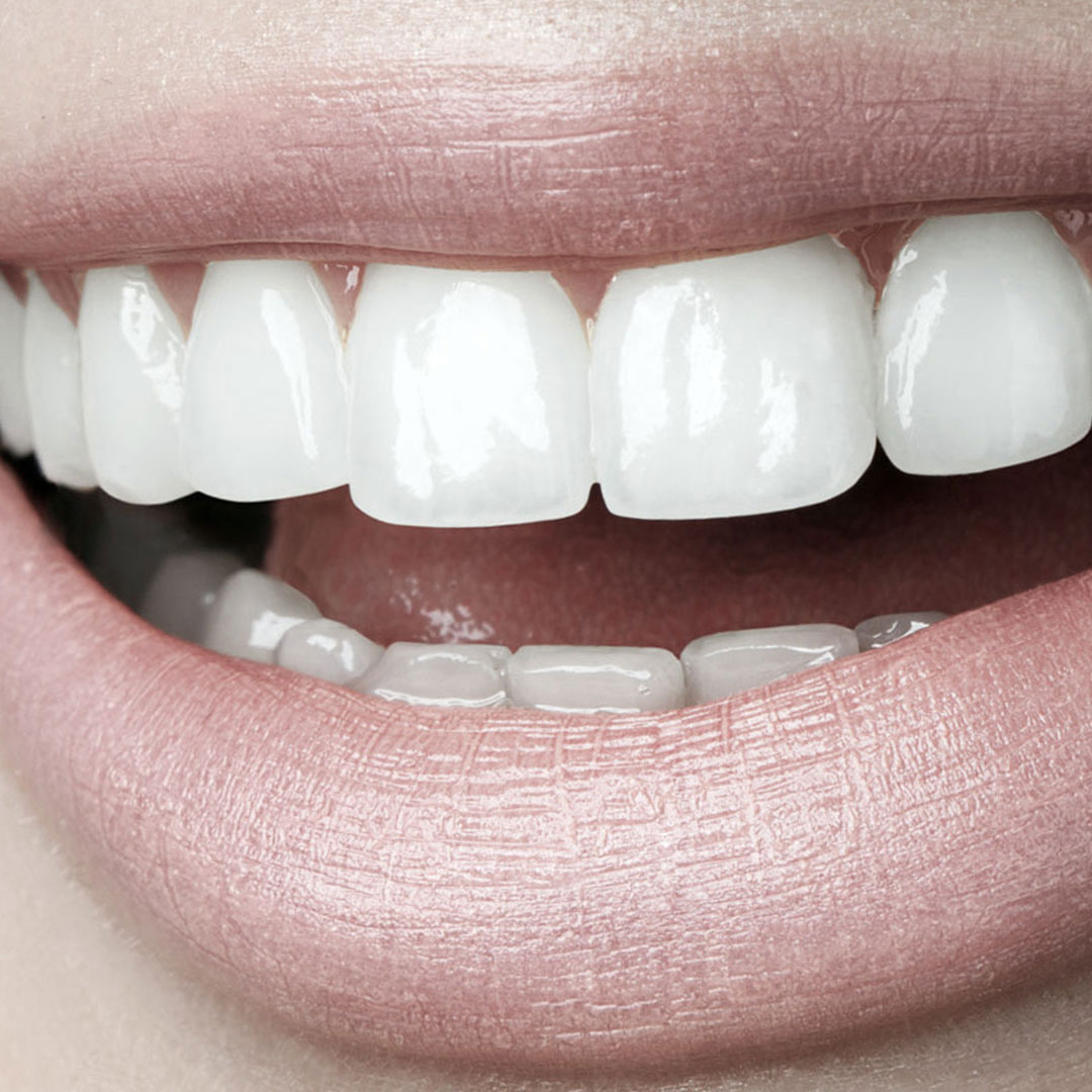 Stages of the Hollywood Smile Procedure