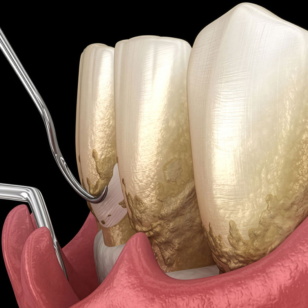 What to Pay Attention to After a Curettage?