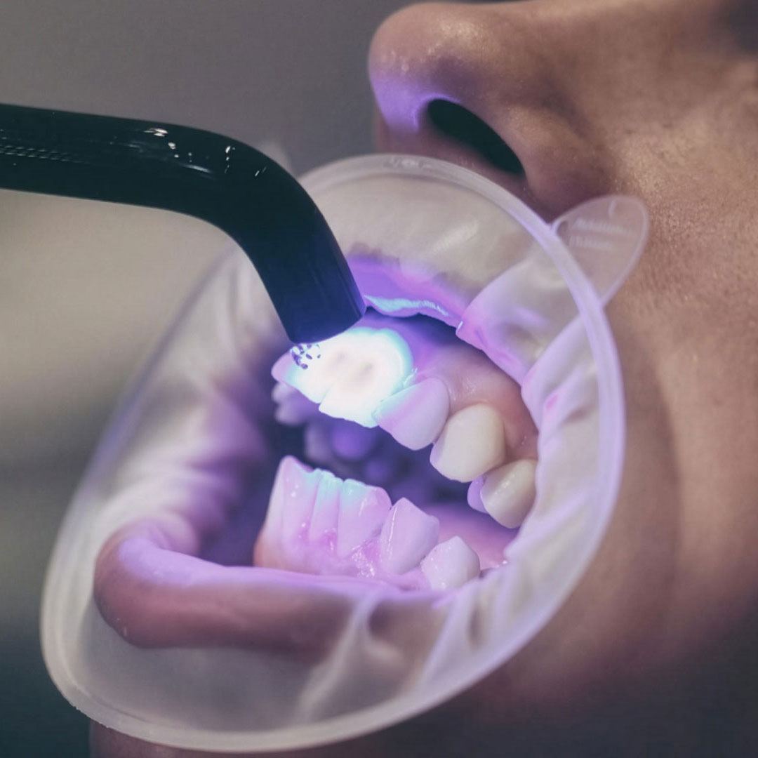 Rubber-Dam Isolation: The Key to Safe and Sterile Dental Treatments