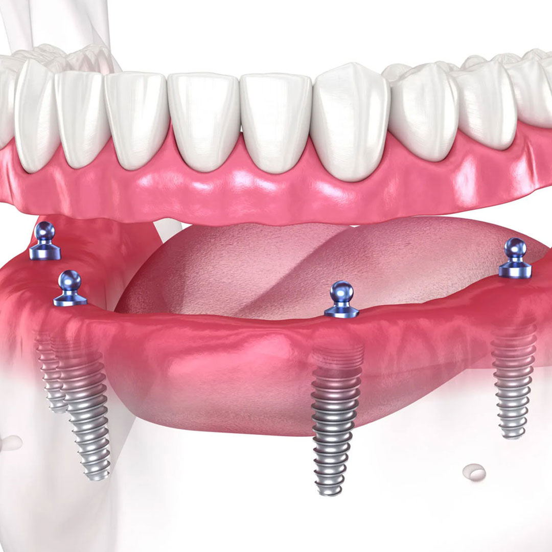 All-on-Four Sistemi Nasıl Çalışır?