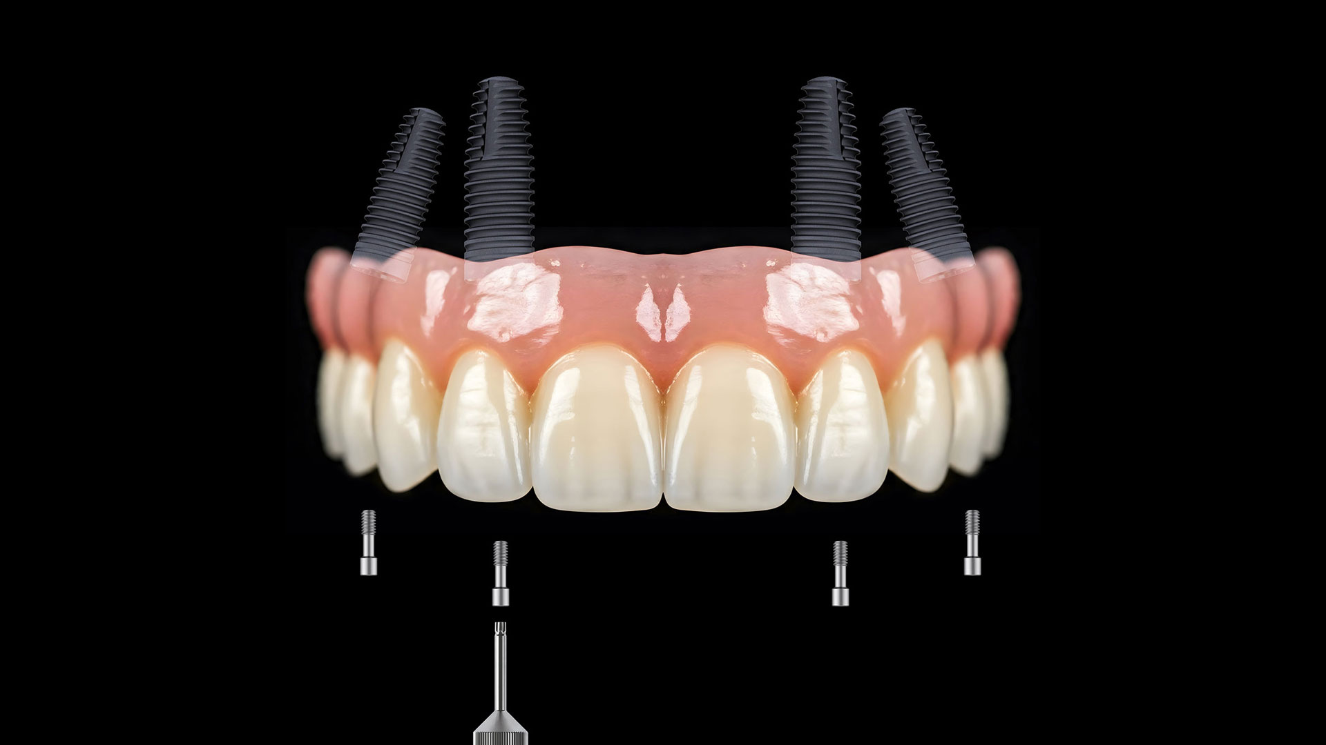 Aynı Günde İmplant Tedavisi