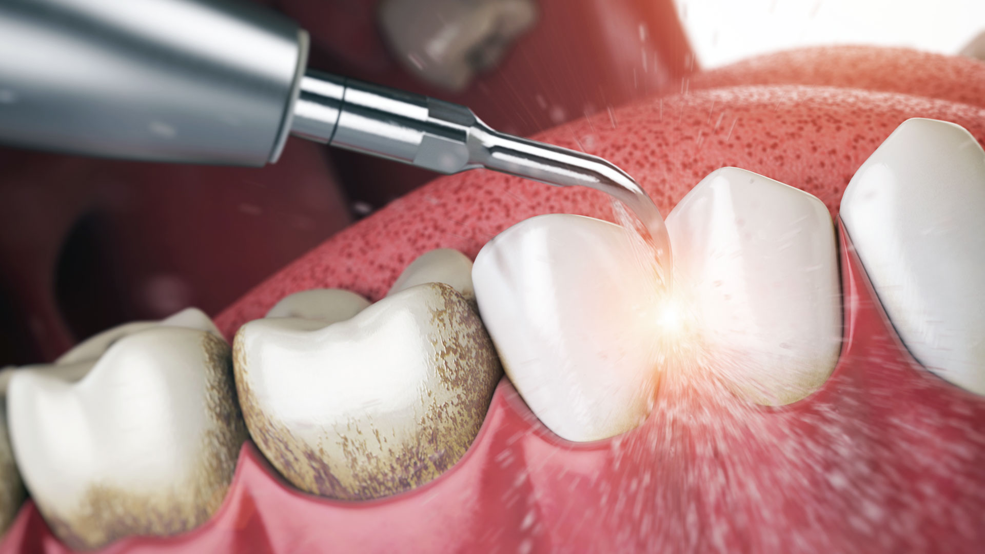 Derin Diş Eti Tedavisi (Küretaj)