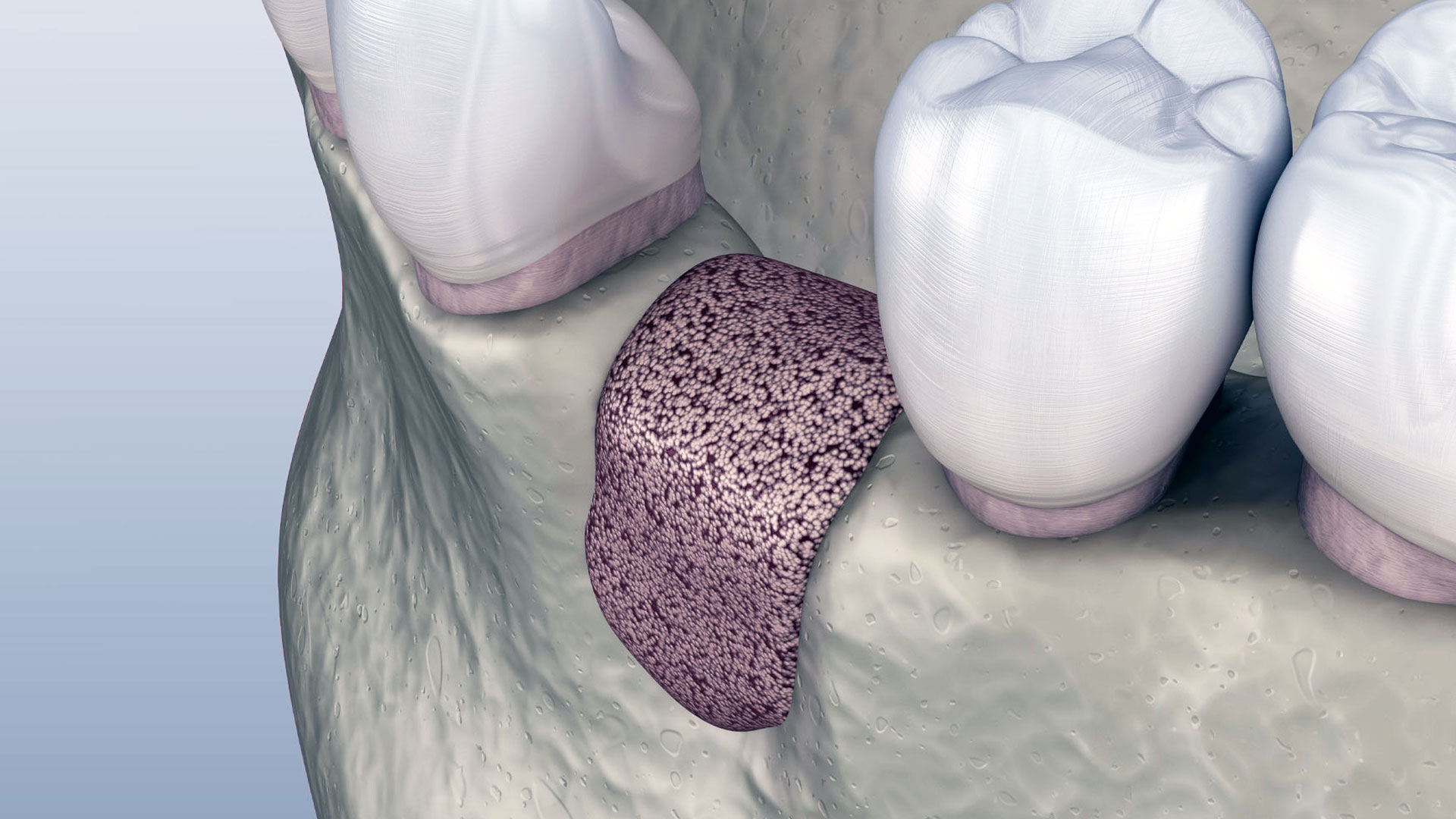 Kemik Grefti Uygulamaları
