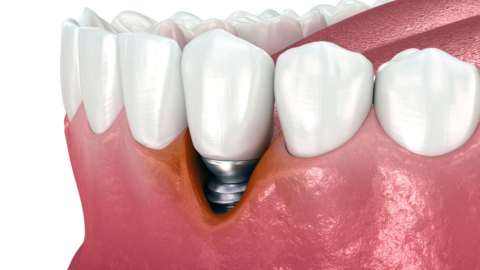 Peri-İmplantitis Tedavisi