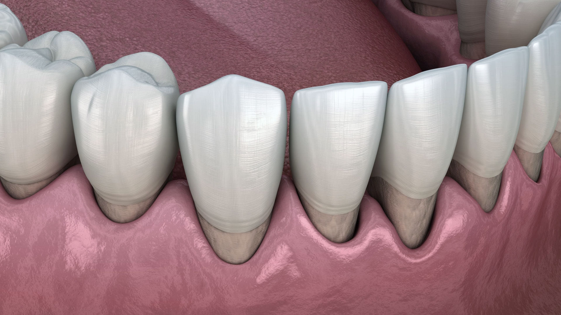 Periodontitis Tedavisi