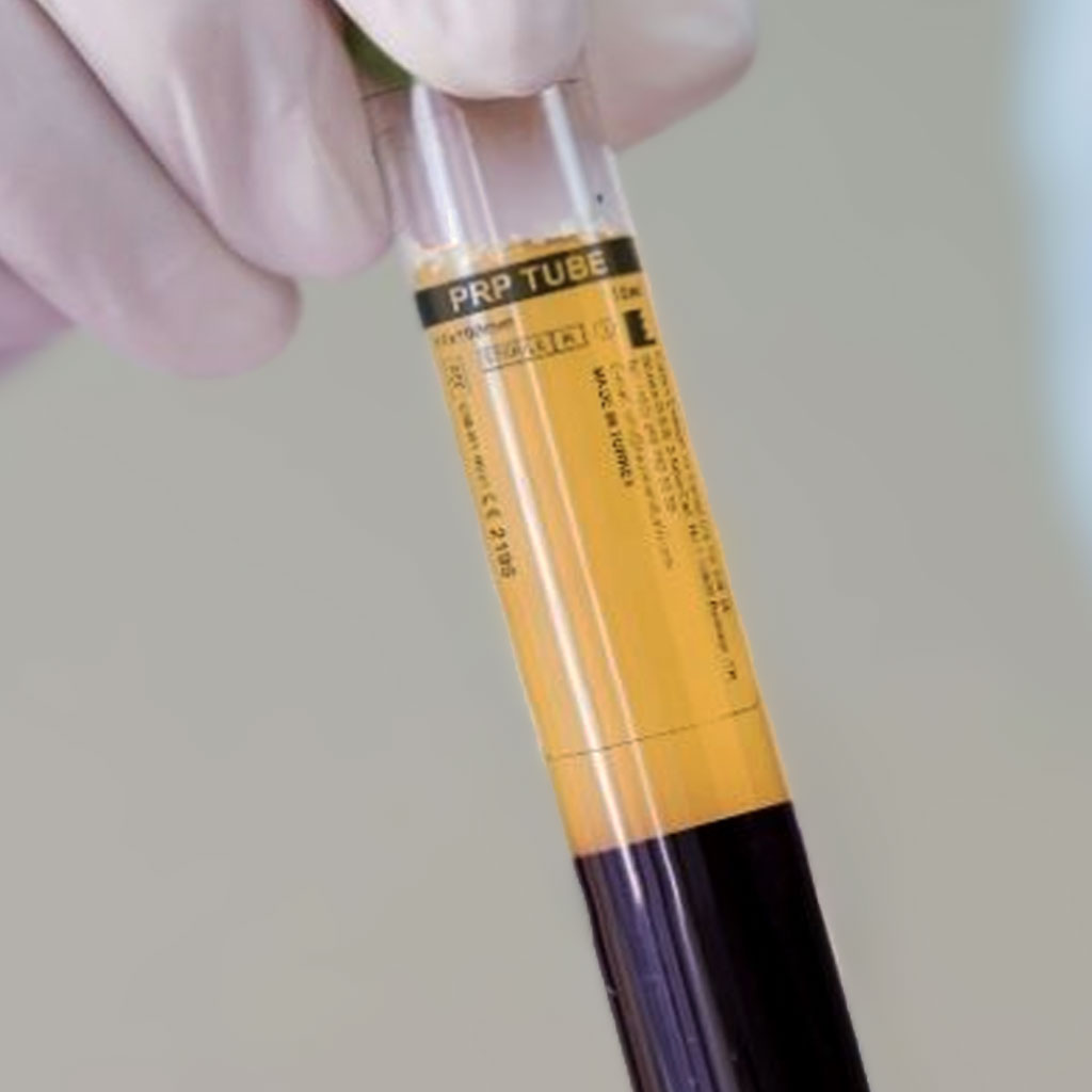 Trombositten Zengin Kan Ürünleri PRF ve PRP Nedir?