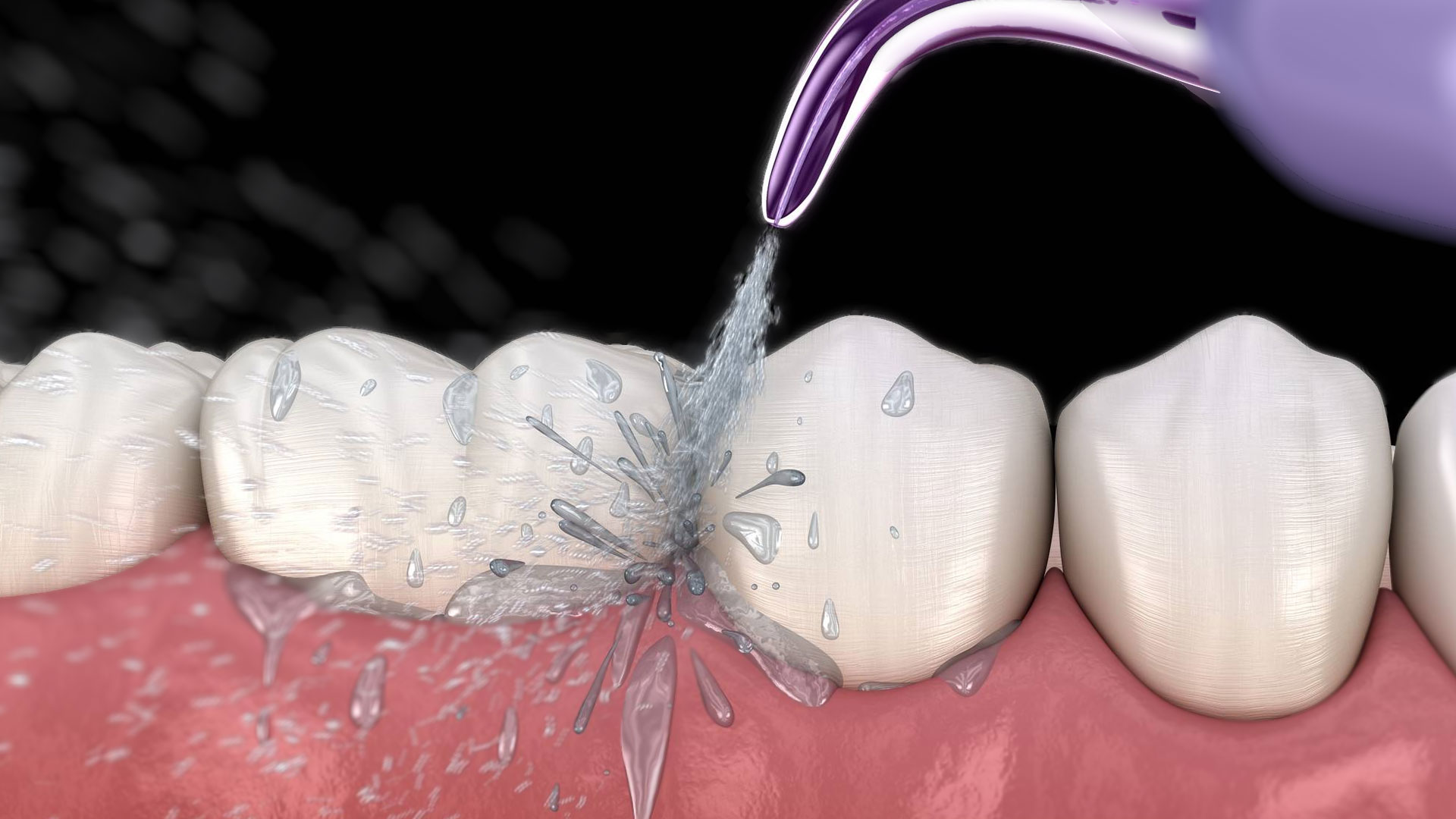 Cerrahi Olmayan Diş Eti Tedavisi